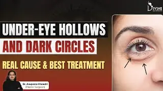 Under-Eye Hollows & Dark Circle - Real Cause & Best Treatment