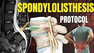 Best Exercises for Spondylolisthesis - Safe Back pain relief & Core support.
