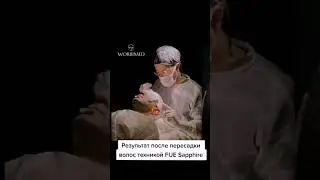 Пересадка волос в Турции |Результат после пересадки волос техникой FUE Sapphire