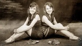 10 Longest Living Conjoined Twins || Pastimers