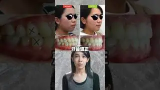 牙齒整齊，咬合超好，還要戴牙套🤔？#骨性暴牙#嘴凸矯正#牙齒矯正