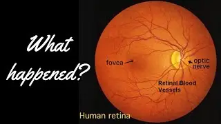 I had a BIG SCARE yesterday! #eyedisorder #medical #ophthalmology #pvd