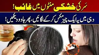 Natural Dandruff Removal Hack | Watch This Video | City 21