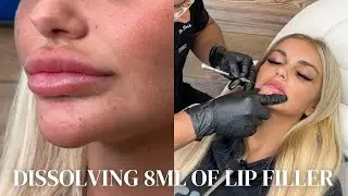 Dissolving 8ml of Lip Filler! Insane Results