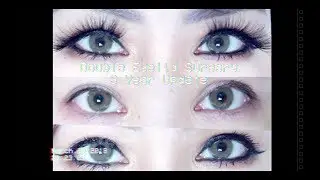 Double Eyelid 3 Year Update
