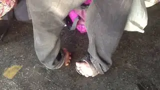Homem com p&eacute;s tortos cong&ecirc;nito 7   Clubfeet man 7