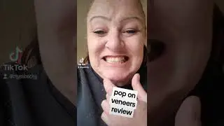 honest review of pop on veneers