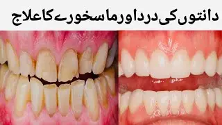 Mas khora ka ilaj | How to get rid of pyorrhea | Teeth whitening | Tips in Urdu Hindi