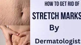 How to get rid of stretch marks by dermatologist &lrm;@skinhealthvitality5959