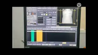 CT Scan KUB procedure and planning