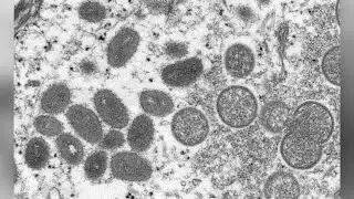 Infectious disease expert explains latest report about US monkeypox infections