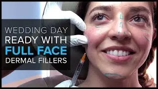 Wedding Day-Ready With Full Face Dermal Filler Treatment at Mabrie Facial Institute