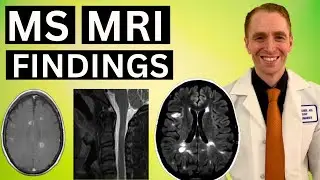 Результаты МРТ-исследования при рассеянном склерозе, разъясненные неврологом.