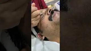microdermabrasion Treatment #headandfaceunisexsalonkochi