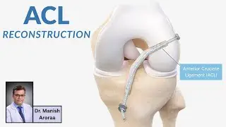 Denoised ACL Reconstruction - Knee Surgery - Dr. Manish Aroraa - Orthopedic Sports Injury Surgeon