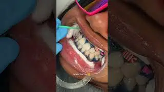 teeth whitening transformation 🦷 #teethwhitening #torontoteethwhitening