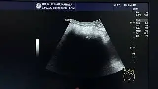 how a retained surgical towel looks like by ultrasound