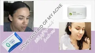 HOW I GOT RID OF MY ACNE!