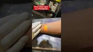 💥Permanent tattoo removal💥#army #police #delhi