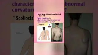 Scoliosis@FreeMedicalEducation-ld3sf#nursing#medical#mbbs#Viral#viralshorts#youtubeviralshorts
