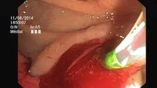 Fully Covered SEMS for bleeding post biliary sphincterotomy