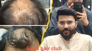 Hair Patch In Rawalpindi | Hair Patch In Pakistan | by Sufyan Rehmani Cont Us 0341_6159414