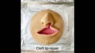 Playdough Surgery 🔪👄 - Cleft Lip Repair