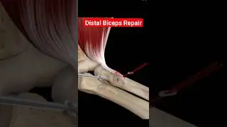 Distal Biceps Repair Surgery #youtubeshorts #shortvideo #shortsviral #shorts #animation #short