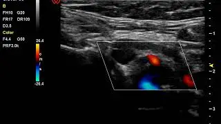 Carotid by Clover 60 Wisonic