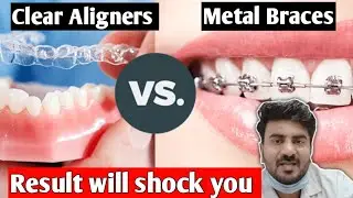 Clear Aligners vs Metal Braces - which is better for teeth gap and irregular teeth