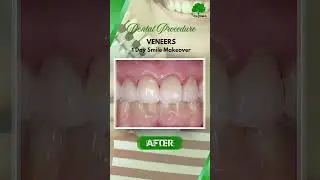 ✨ Transform Your Smile in Just One Day! ✨