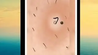 pimples removal| pimple asmr animation| pimple kese hatye