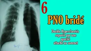 Telethorax 6 : PNO brid&eacute; ( Syndrome pleural : Hyperclaret&eacute; en bande)