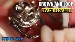 Crown and Loop Space Regainer | step by step