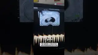 8 Weeks Pregnant | Baby Movements, Heartbeat & Ultrasound | Mamata Fertility Hospital: Hyderabad
