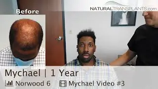 2nd Hair Transplant Procedure for Male Pattern Baldness | Dr. Harold Siegel (Mychael)