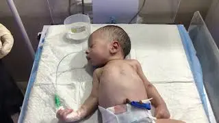 After Stomach Wash: Introducing NG Feeds for Babies NG Feeding for Newborns: #babycare #nicucare 