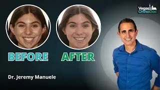 Am I a Candidate for Invisalign or Clear Aligners?