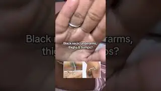 #drmelaxin #bodypeelshot#tumeric Melaxin Official #darkthighs #hyperpigmentation results may vary