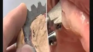 Protesi avvitata Bedent.mp4