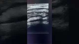 Ulcerative colitis ultrasound #ultrasonography #ultrasoundmadeeasy