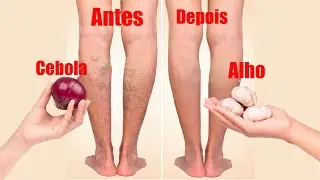 Adeus Varizes e Dor nas PERNAS! Dica simples e f&aacute;cil que apagou as varizes! 🤯