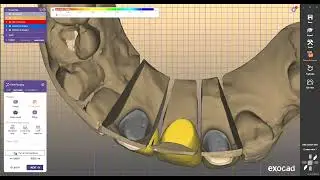 #inlab  #cerec  #millbox    #Exocad #Exoplan #Ceramill #Maestro3D #RealGuide #hyperdent  #3shape