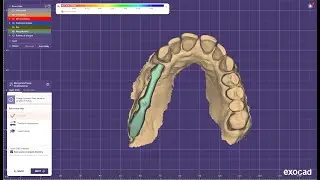 Titanium partial bar designing for single piece implant in Exocad Elefsina