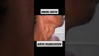 Dancing carotid/Corrigan's Sign Aortic Regurgitation #mrcp #usmle  #neetpg2025 #aorta #regurgitation