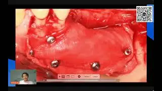 Webminar Bone Grafting (Urban) - Dr Ho&agrave;ng Việt
