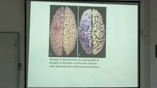 Lecture On Cellular Adaptation & Aging: Hypertrophy, Atrophy, Metaplasia, Dysplasia | MBBS