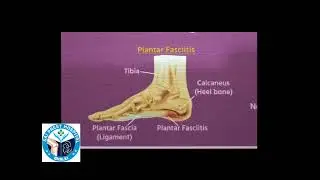 PLANTAR FASCIITIS|| HEEL PAIN || AVOID HIGH HEELS 👠