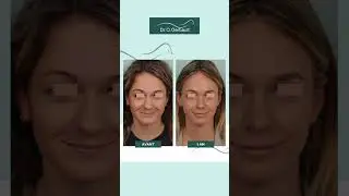 Evolution dans le temps de la rhinoplastie ultrasonique