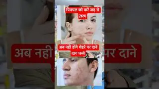 Pimples ke liye or nisan k liye cream #skincare #beauty #skincareroutine #pimple #acne